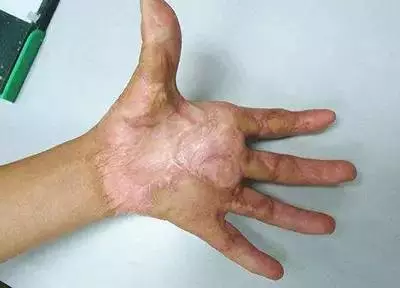 手部烧伤后,瘢痕挛缩怎么办?
