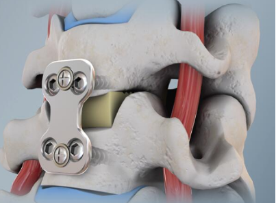 人工椎间盘图片