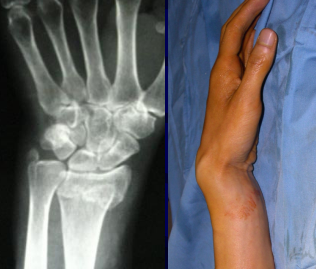 正常左手尺骨桡骨图片图片