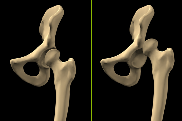 成人ddh的全髋关节置换技术