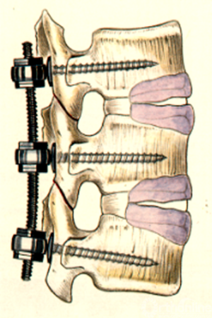 腰椎骨折钉棒内固定术图片