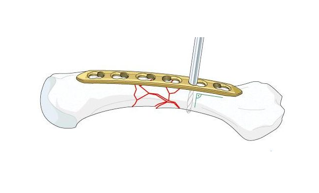 股骨干骨折内固定图片