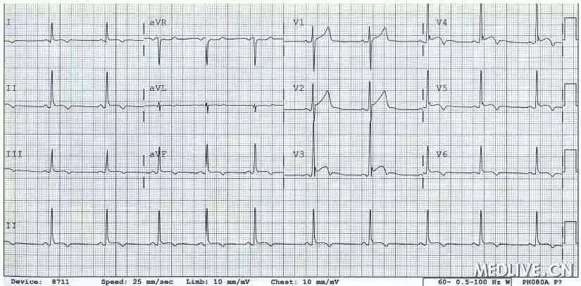 st段抬高心电图标准图片
