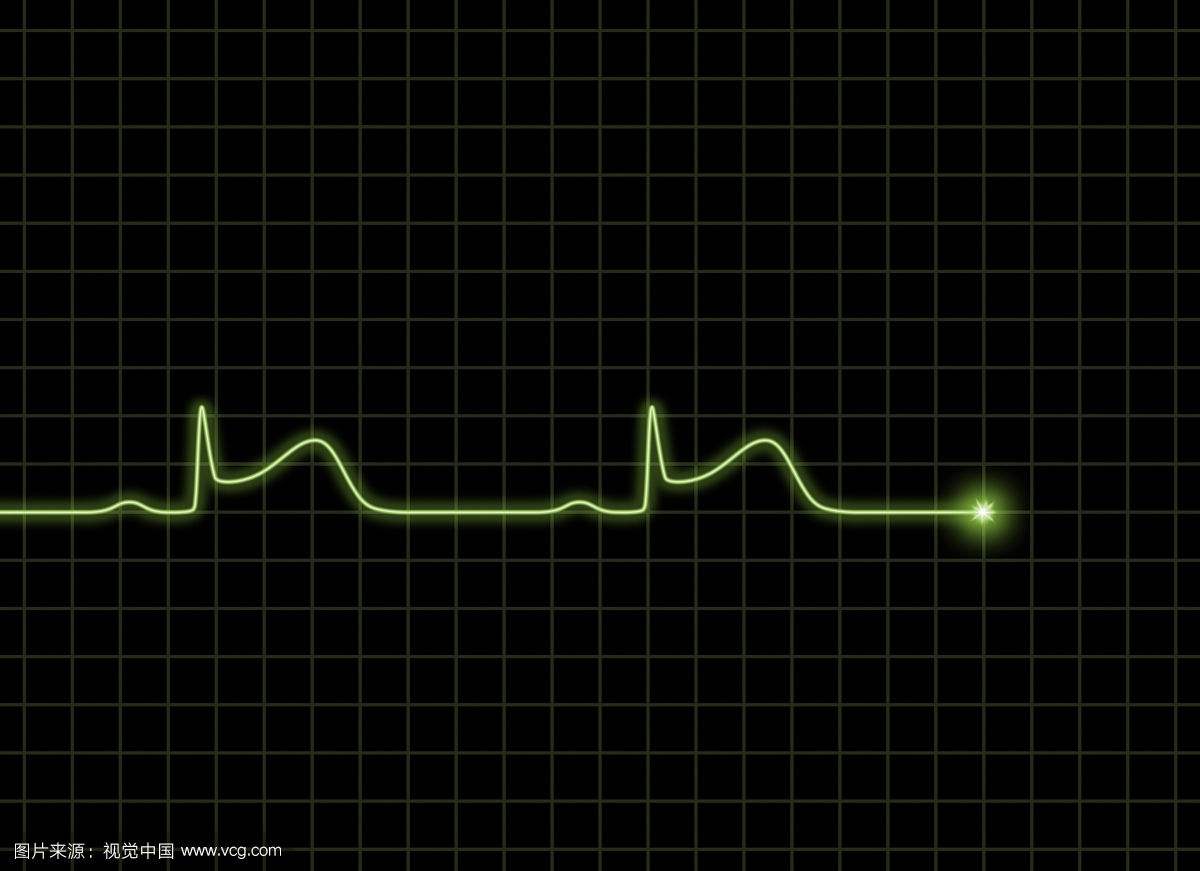 ECG