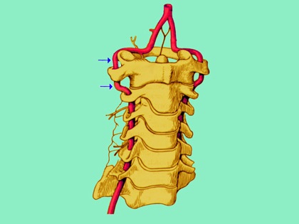 椎动脉:脊柱外科医生最头痛的血管!