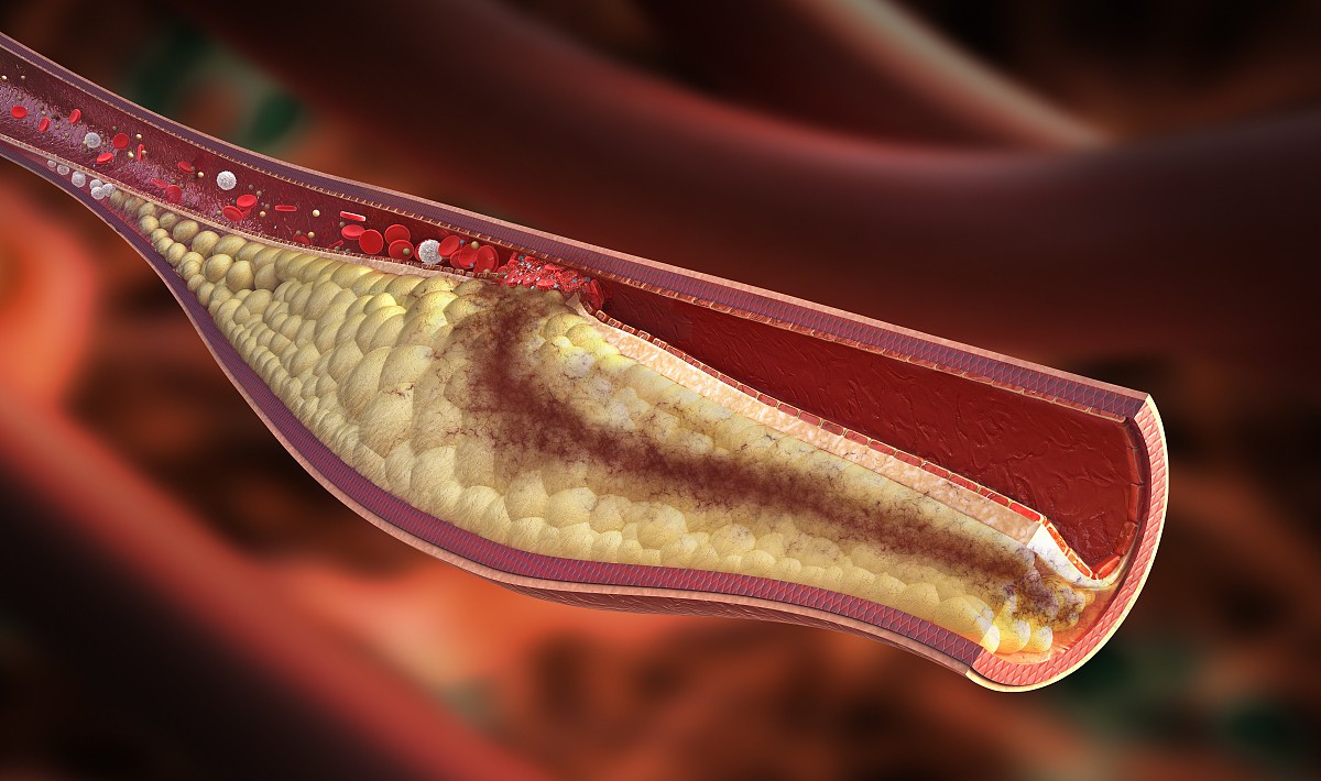 动图演示,动脉粥样硬化的形成与危害!